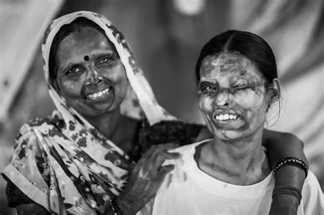 Acid Attack Survivors in india.